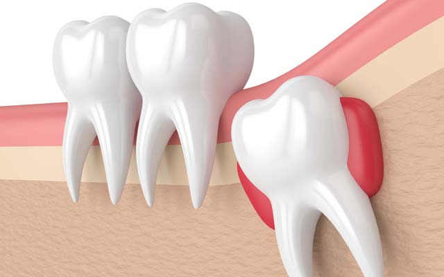 Что такое киста зуба и как ее вылечить