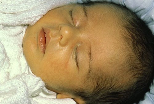 Применение галстены от желтушки у детей и новорожденных