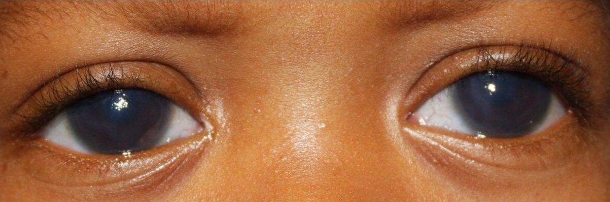 Бринзопт - капли глазные: инструкция по применению от глаукомы и .