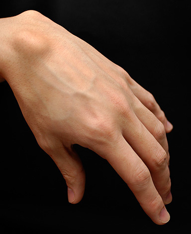 Что такое гигрома на запястье руки, почему возникает, как лечить