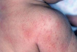 Токсикодермия (токсико-аллергический дерматит): причины, проявления и лечение
