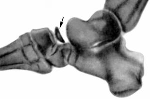 Стопа: остеохондропатия льдьевидной кости стопы (болезнь келлера)