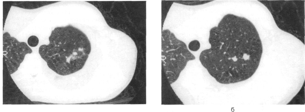 Туберкулез кт картина