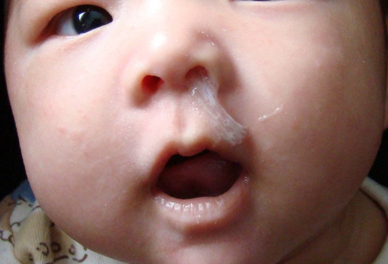 отек носа у ребенка фото