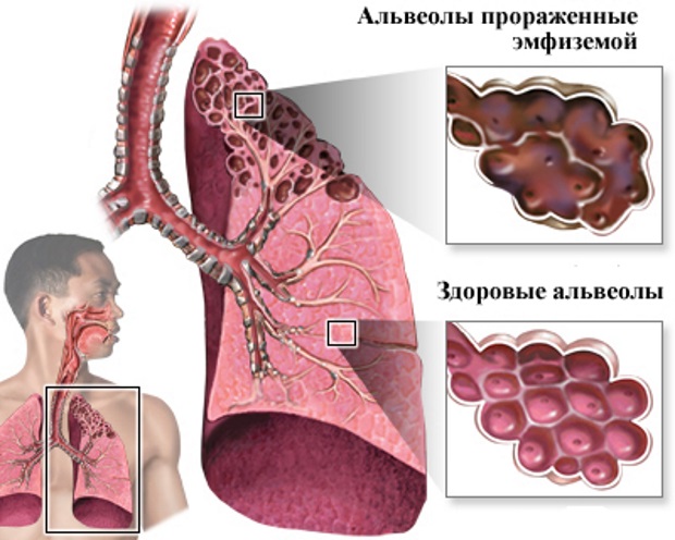 Эмфизема легких картинки