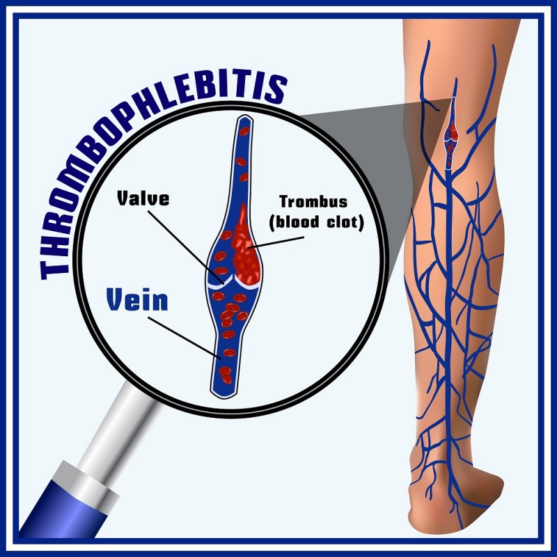 Тромбозы и тромбофлебиты вен нижних конечностей: этиология, диагностика и лечение