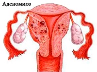 Аденомиоз матки – диффузный и узловой, симптомы и признаки, алгоритм лечения,  народные средства