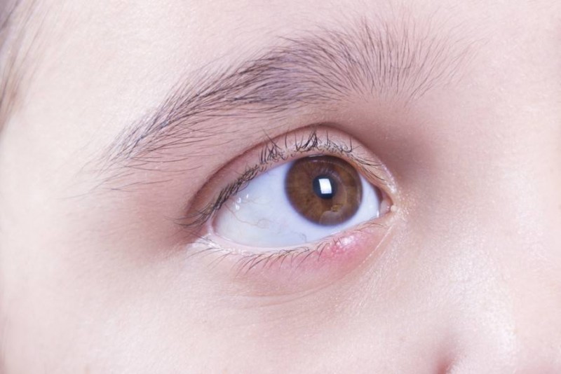 Бактериальный конъюнктивит глаз лечение у взрослых капли