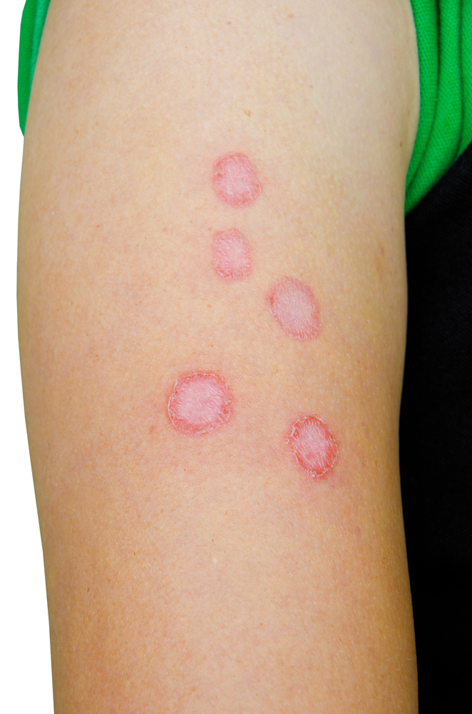 Микроспория гладкой кожи: симптомы, признаки и лечение