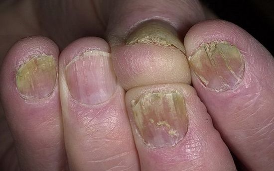 Грибок ногтей на руках (онихомикоз): симптомы, лечение. фото