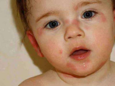 Может ли быть у ребенка аллергия на кабачок? первый прикорм