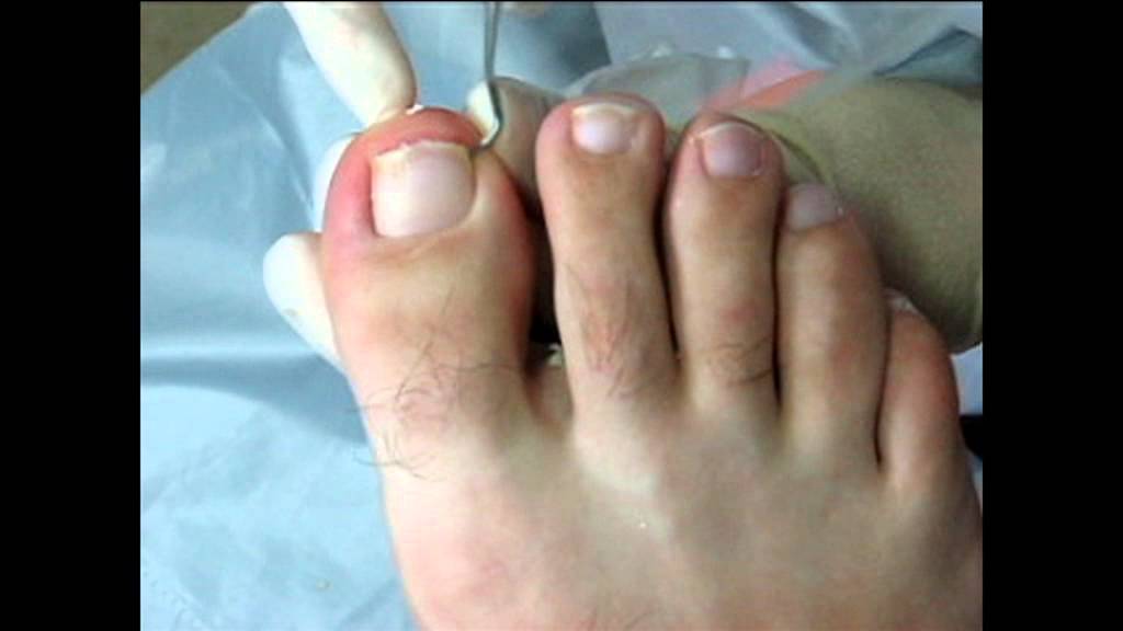 Вросший ноготь на большом пальце ноги: способы лечения