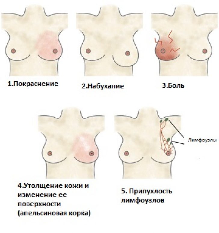 Мастит - мастит симптомы - запись пользователя printemps (printemps) в сообществе грудное вскармливание в категории лактостаз, мастит - babyblog.ru