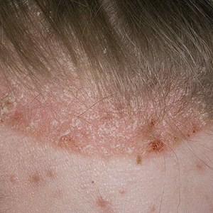 Грибок кожи (микоз): виды, лечение и фото