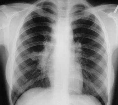 Пневмония и рентген