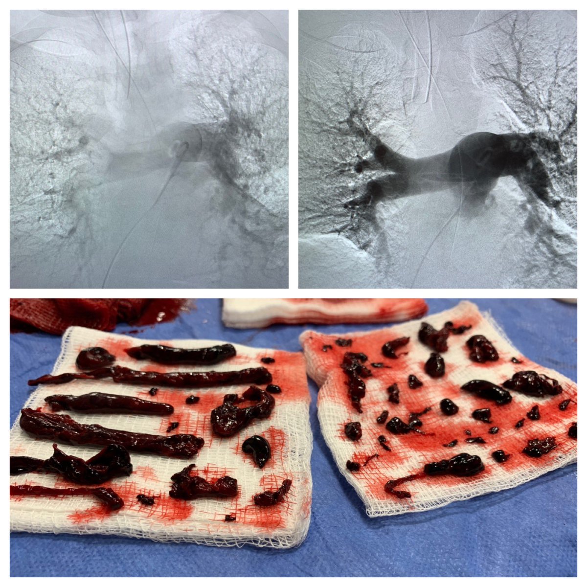 Тромбоэмболия легочной артерии и ее ветвей. лечение