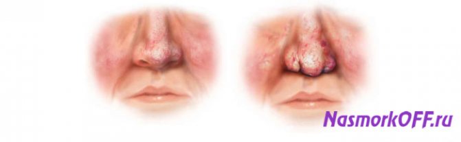 Базалиома кожи носа — раковая опухоль, но не приговор