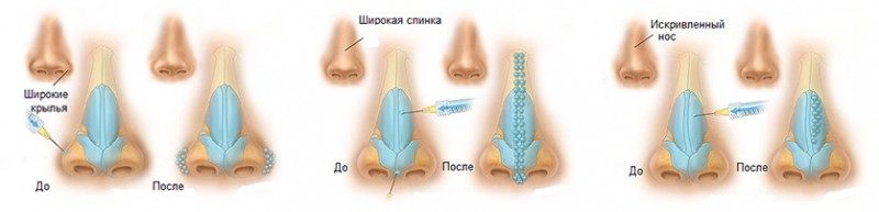 Коррекция формы и функции носа (риносептопластика)