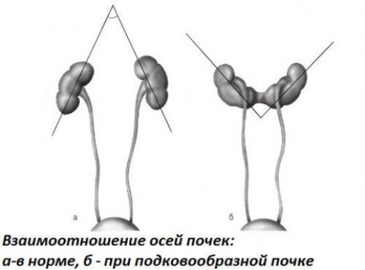 Подковообразная почка у ребенка чем опасна