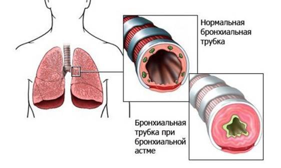 Этиология и патогенез бронхиальной астмы