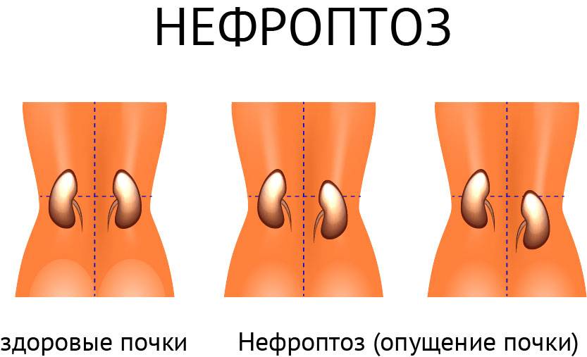 При кашле болит справа под ребрами сбоку что