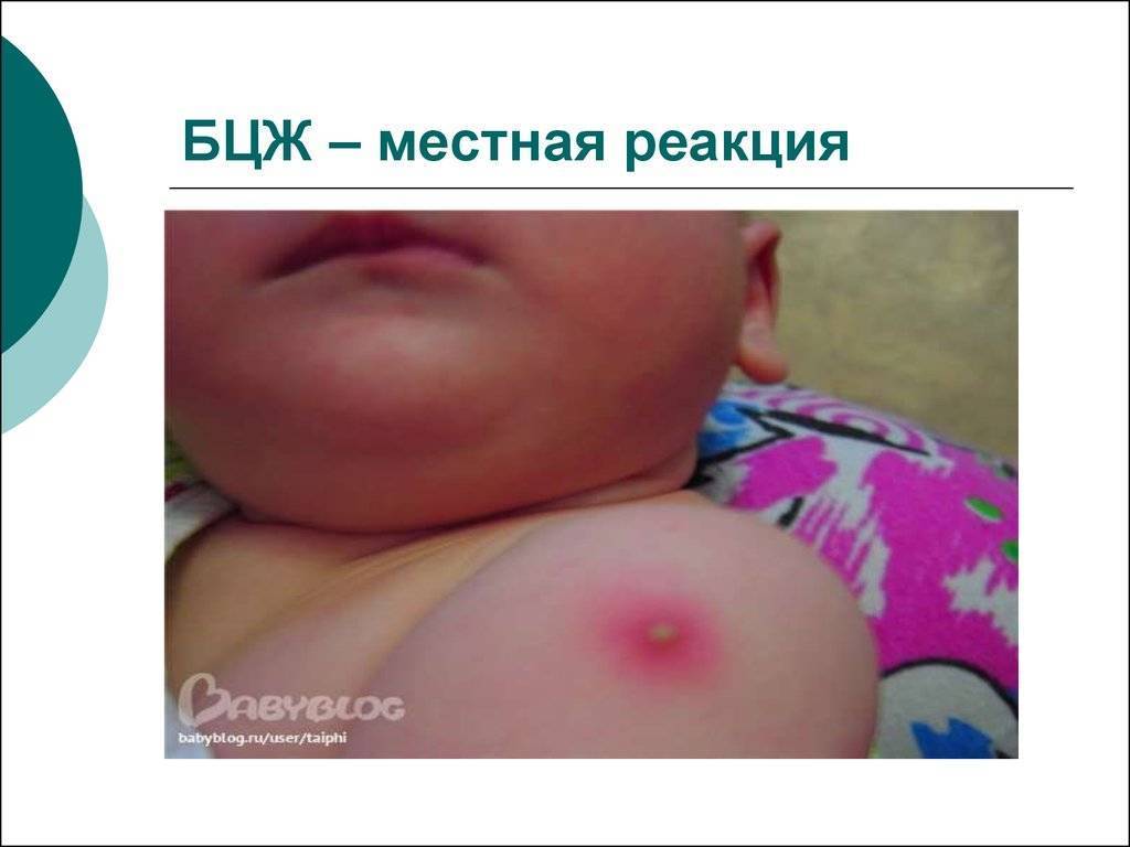 Аллергия на манту у ребенка: фото и симптомы