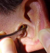 Ушная пробка признаки. бывает ли боль в ухе при серной пробке? удаление ушной пробки в домашних условиях.