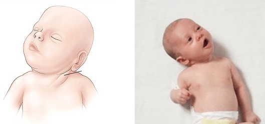 Кривошея у новорожденных. причины, признаки, фото и лечение