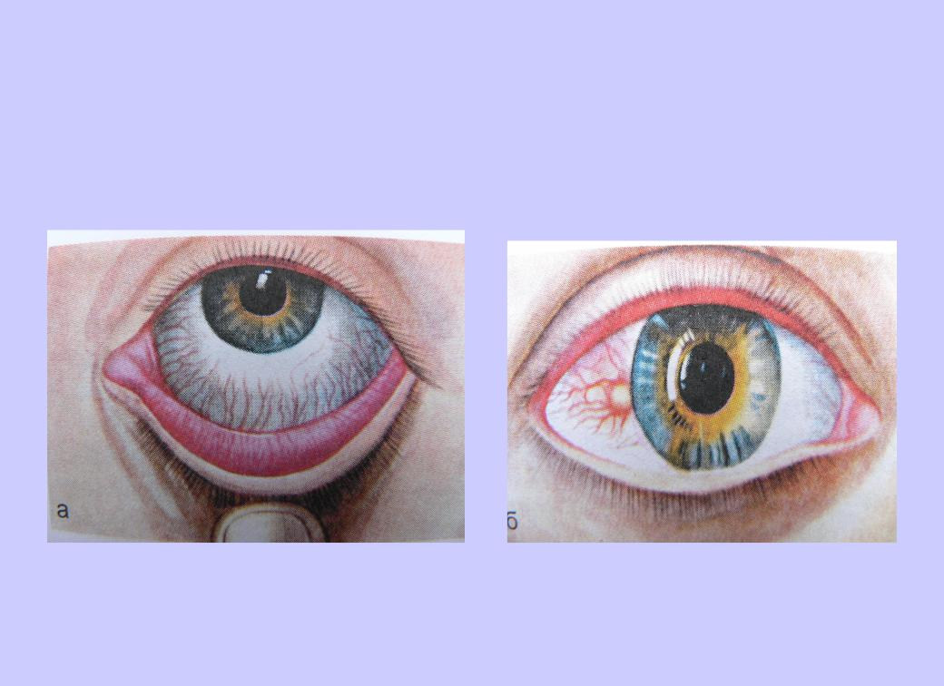 Воспаление роговой оболочки глаз (кератит): что это такое и как лечить