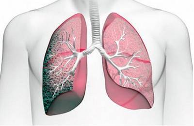 Осложнения и последствия туберкулеза: сердечная недостаточность, отеки и посттуберкулезные изменения