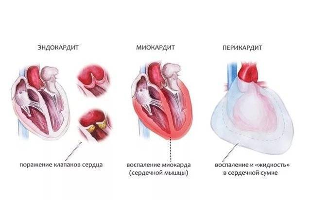 Тонзиллит с одной стороны фото