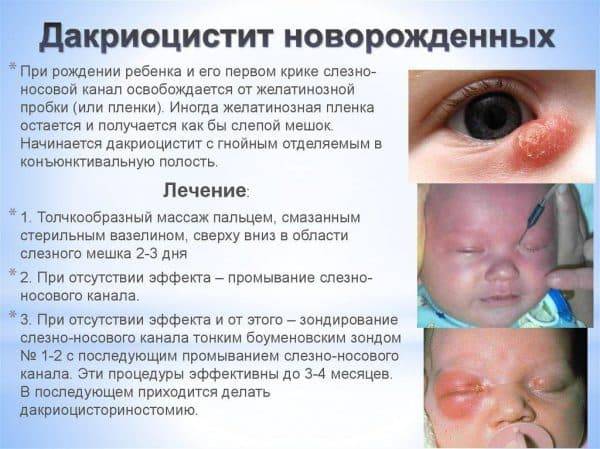 Чем промывать глазки новорождённому?