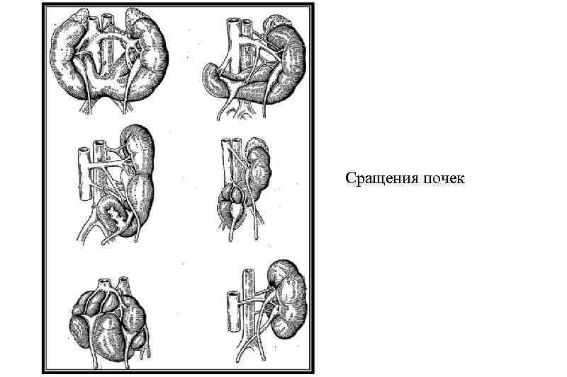 Подковообразная почка у ребенка чем опасна