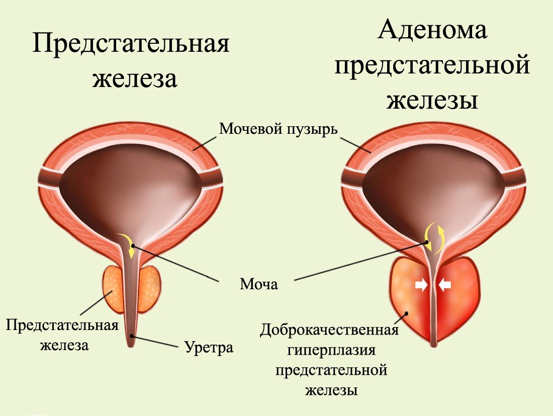 Аденома простаты (увеличение предстательной железы)