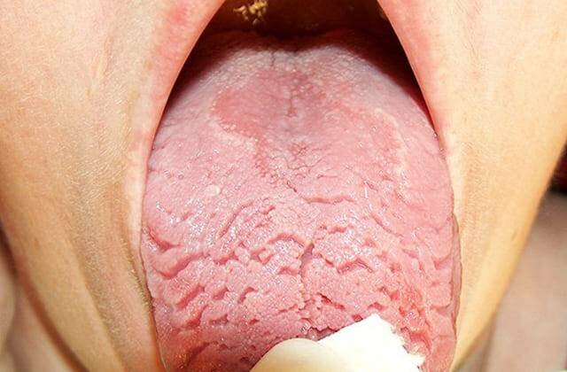 Воспаление языка — причины, симптомы, лечение. как лечить воспаление ротовой полости и языка?