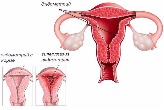 Определение простой гиперплазии эндометрия без атипии: лечение, отзывы женщин