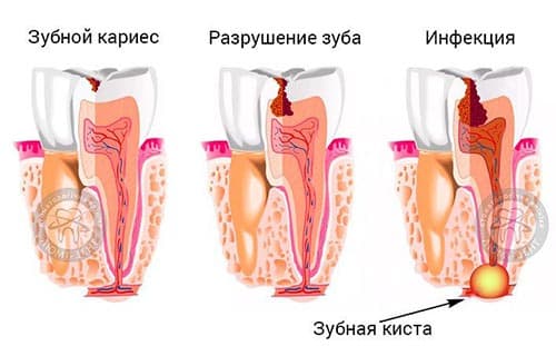 Что такое киста зуба, какие симптомы и методы лечения?