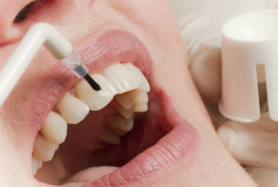 Как восстановить зубную эмаль дома стоматологические и народные методы