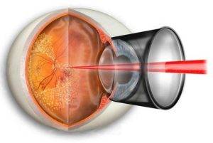 Симптомы глаукомы на ранних стадиях