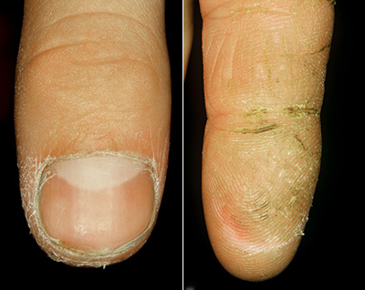 Как справиться с грибком на пальцах рук: методы лечения