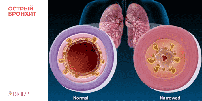 Пневмония при бронхиальной астме