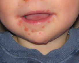 5 важных симптомов - не пропустите! стоматит аллергический: лечение у взрослых и детей