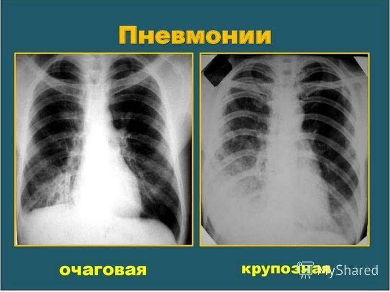 Пять отличий пневмонии и туберкулеза