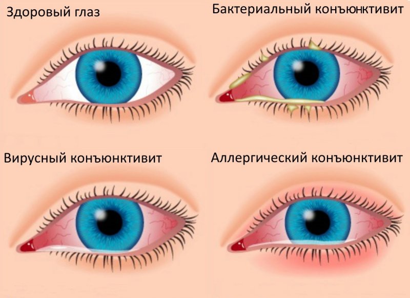 Как применять тетрациклиновую мазь для глаз