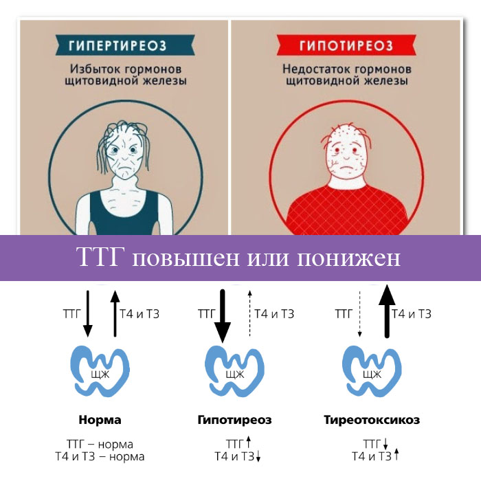 Тиреотоксикоз и гипотиреоз: как распознать вовремя отклонения в работе щитовидной железы