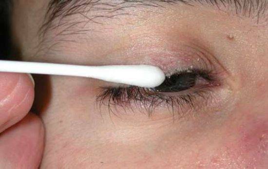 Что такое мейбомит глаза: причины и лечение