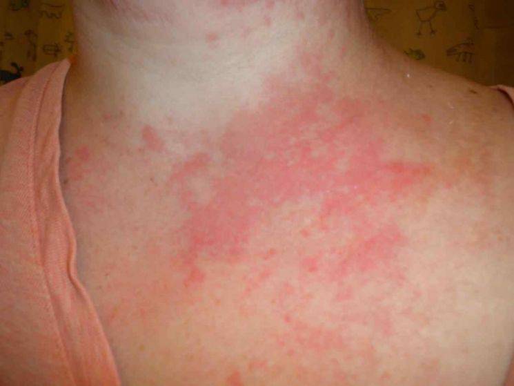 Как выглядит медикаментозная аллергия: симптомы и фото. симптомы .