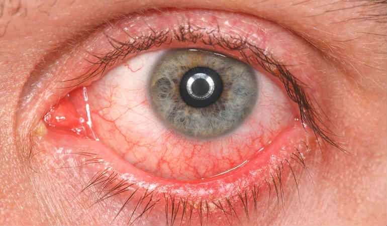 Признаки глазного давления у взрослых: как проявляется повышенное вгд