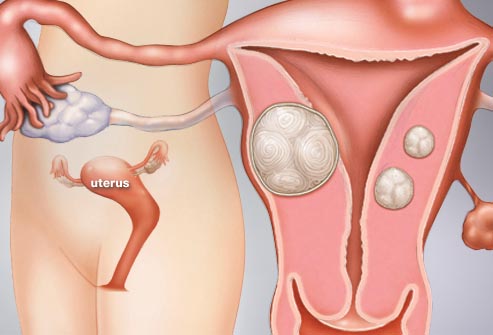 Аденомиоз матки — что это такое, причины, признаки, симптомы, степени и лечение