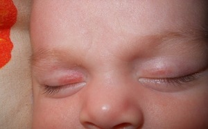 Гемангиома на коже у ребенка: причины возникновения и лечение